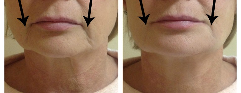 Other Dermal Fillers