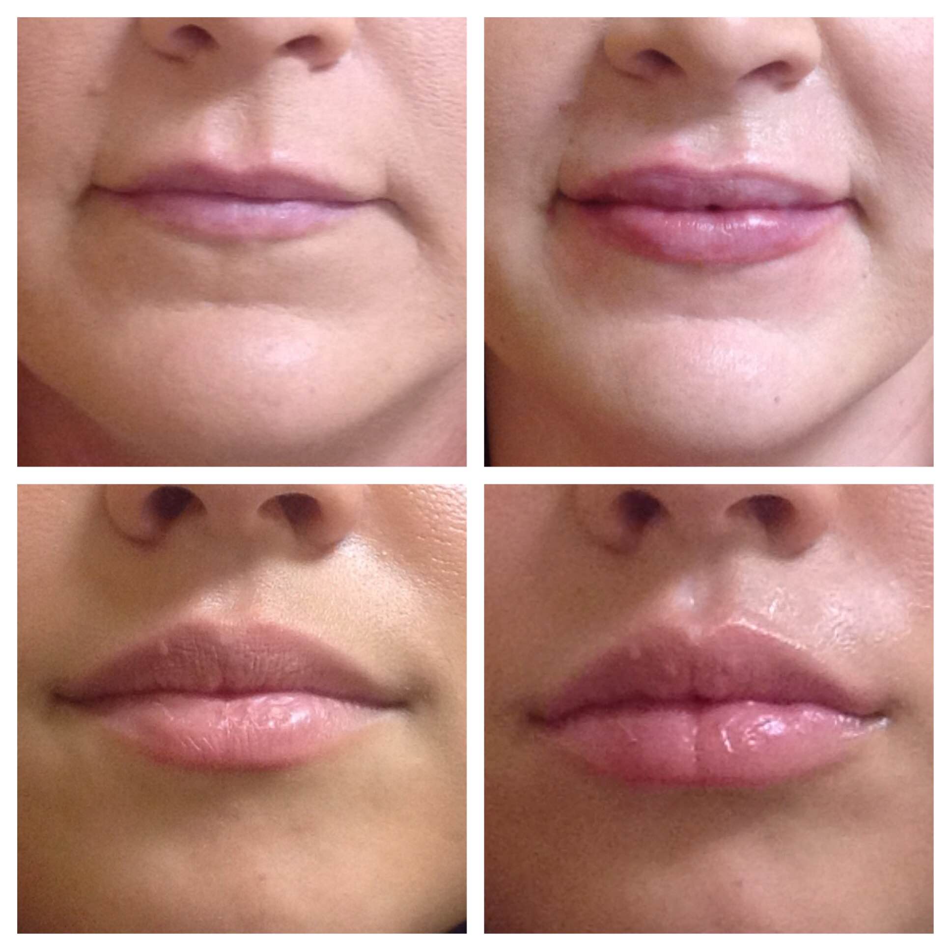 lips-filler