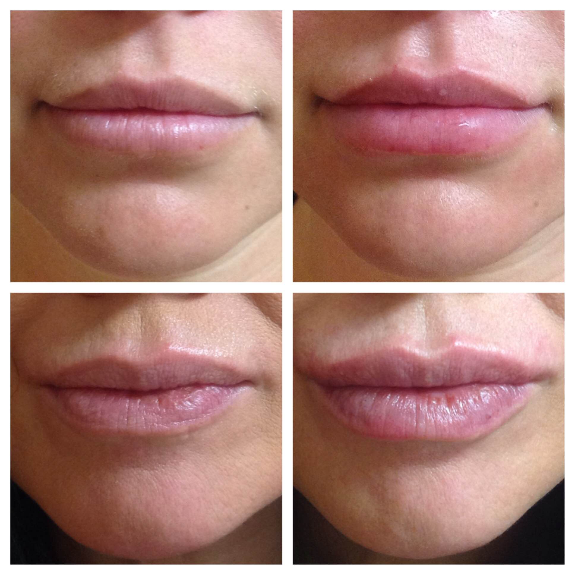 Lips Filler