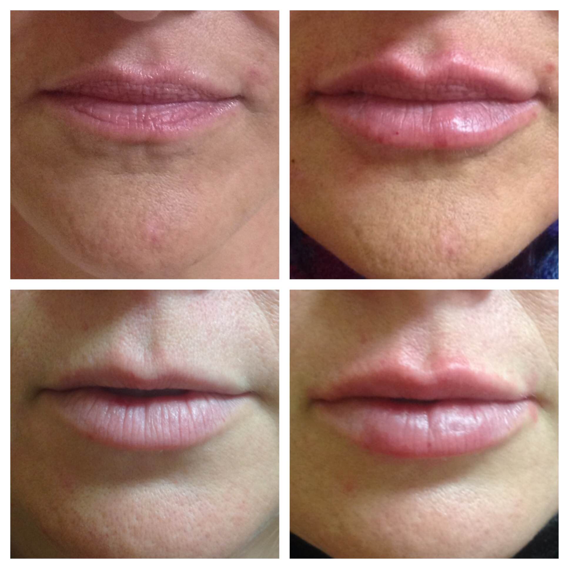 lip-filler-experience-start-to-finish-with-1-syringe-of-juvederm